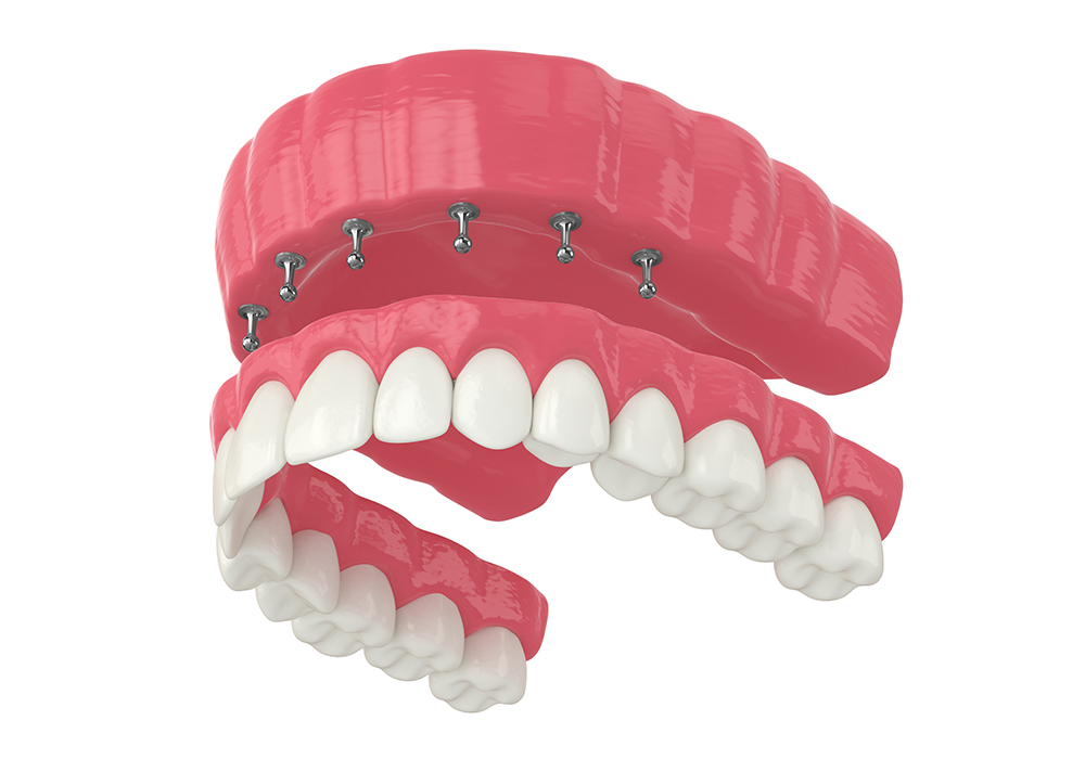 Benefits & Drawbacks of Snap-In Dentures