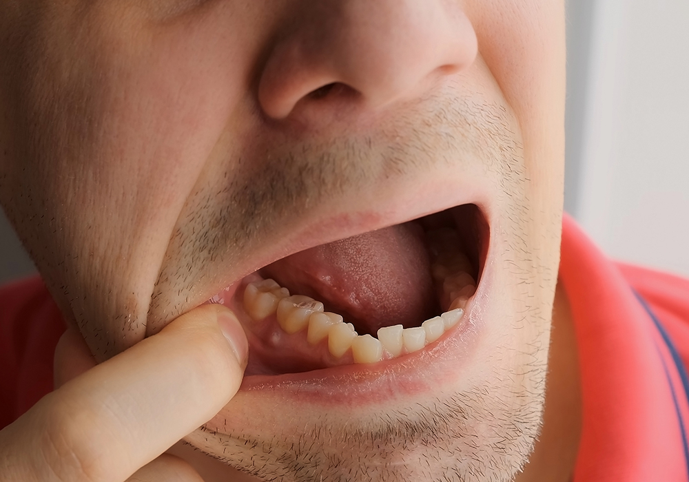 Man showing swollen gums from tooth abscess