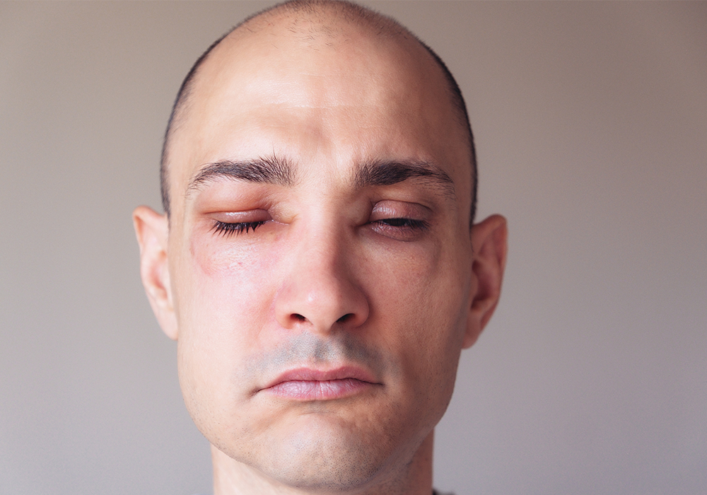 Man with facial swelling needing 24 Hour Dental Emergency