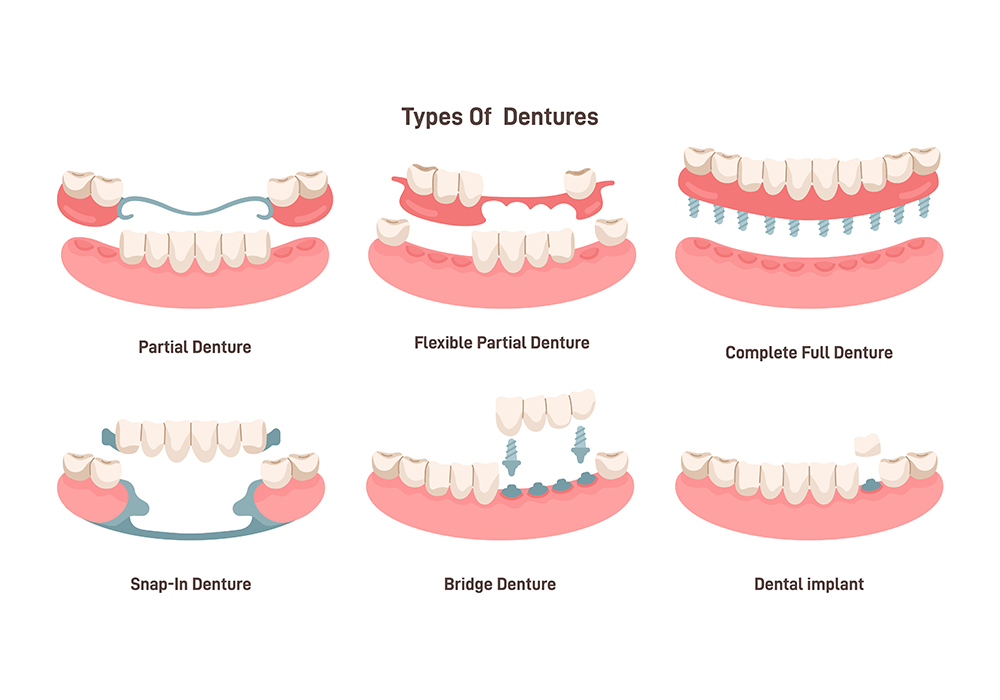 Benefits & Drawbacks of Snap-In Dentures